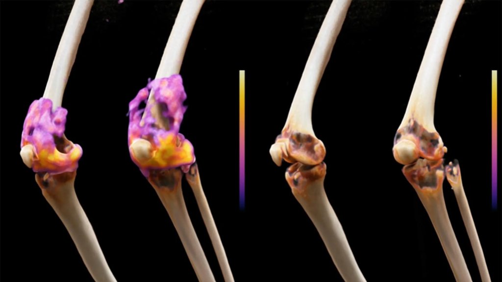 A cancer therapy put severe rheumatoid arthritis into remission | ScienceDaily