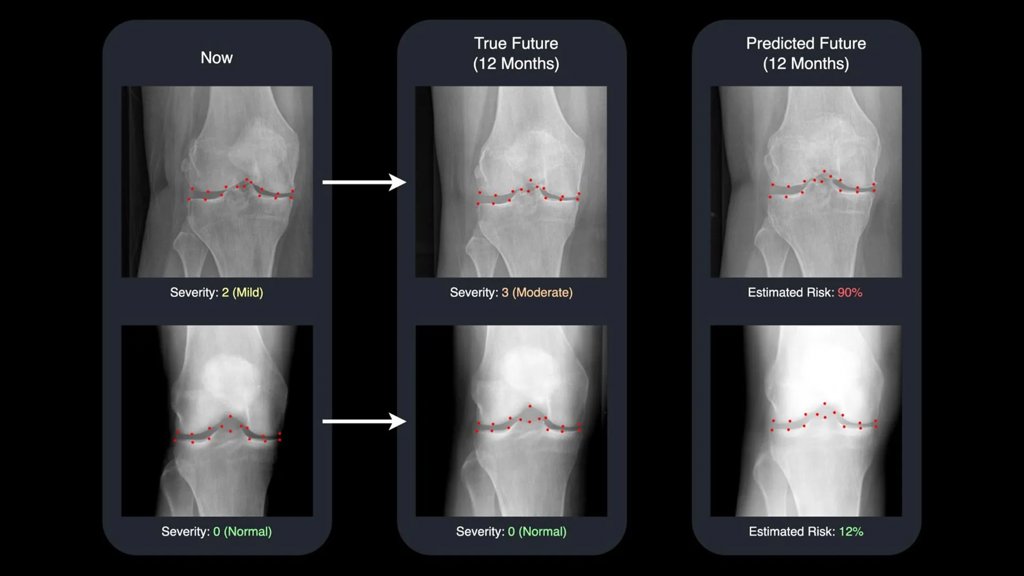 AI turns x-rays into time machines for arthritis care | ScienceDaily