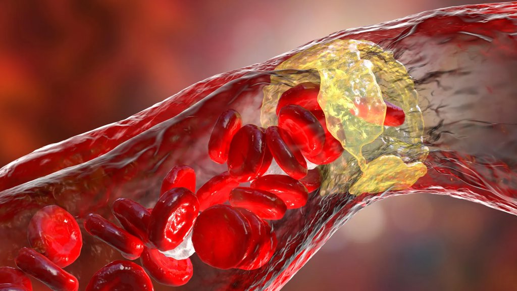 Powerful cholesterol drug cuts heart attack risk by 31% | ScienceDaily