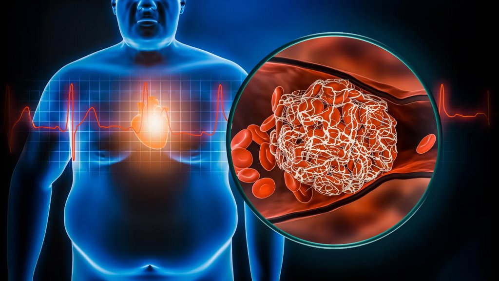Men and women with obesity face very different hidden health risks | ScienceDaily
