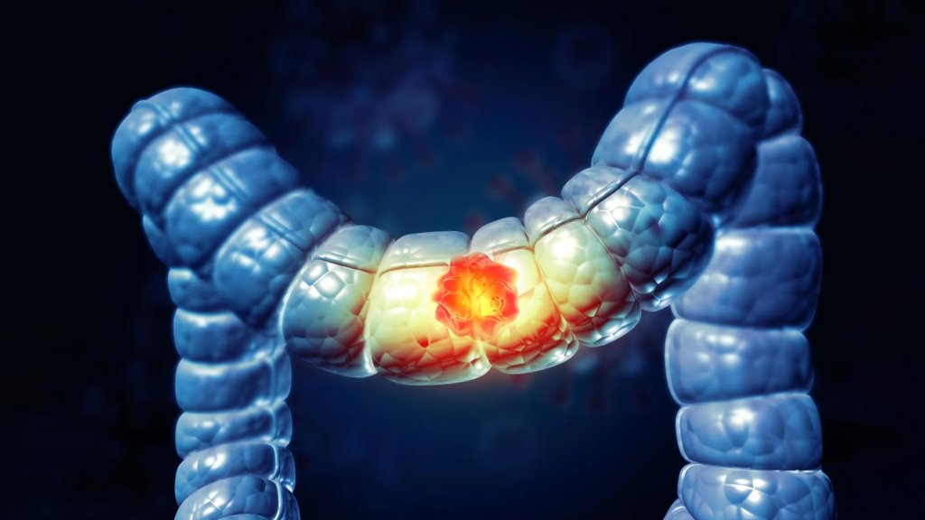 Most Americans don’t know this food raises colon cancer risk | ScienceDaily