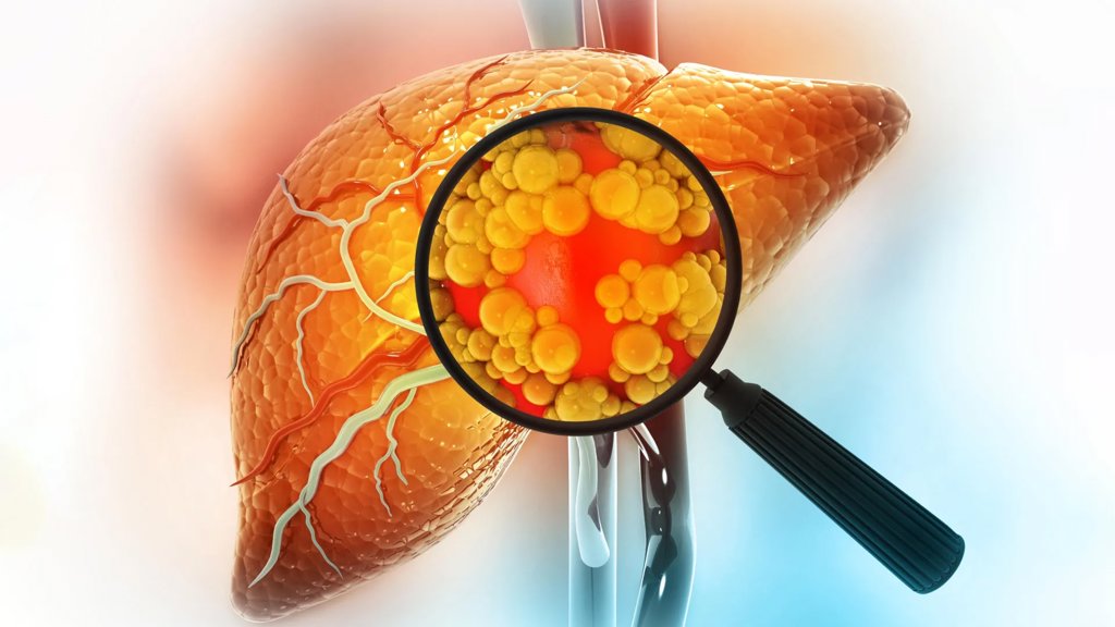 A simple drug pair may succeed where liver fibrosis treatments failed | ScienceDaily