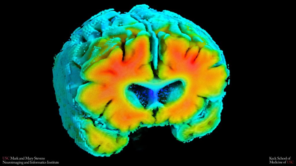 Alzheimer’s may begin with a silent drop in brain blood flow | ScienceDaily