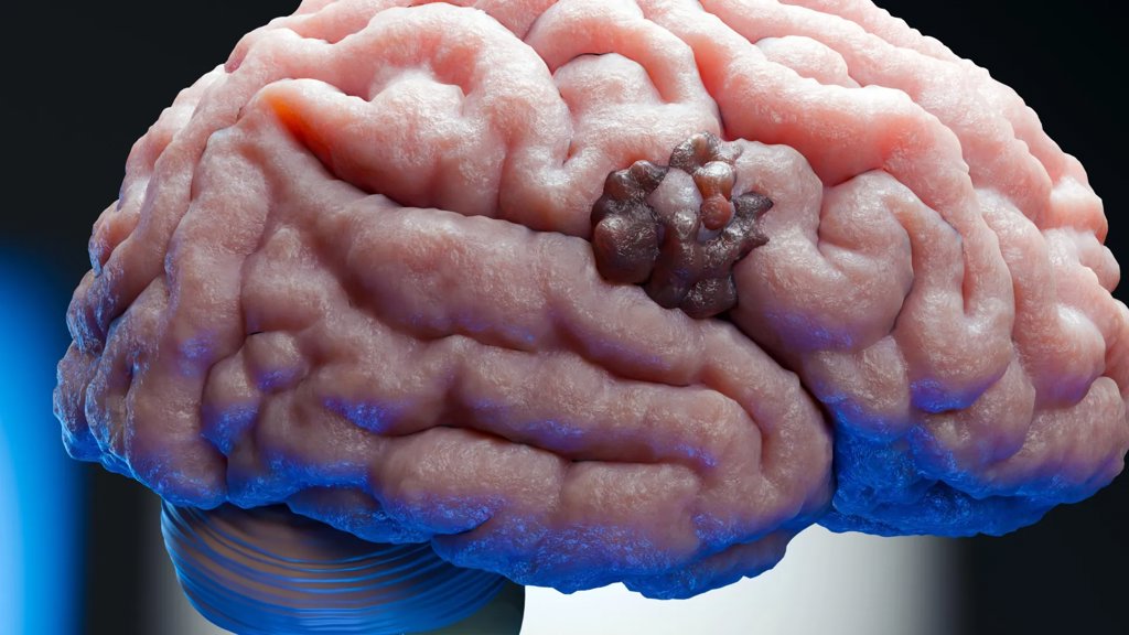 A 70-year-old pregnancy drug just revealed a hidden weakness in brain cancer | ScienceDaily