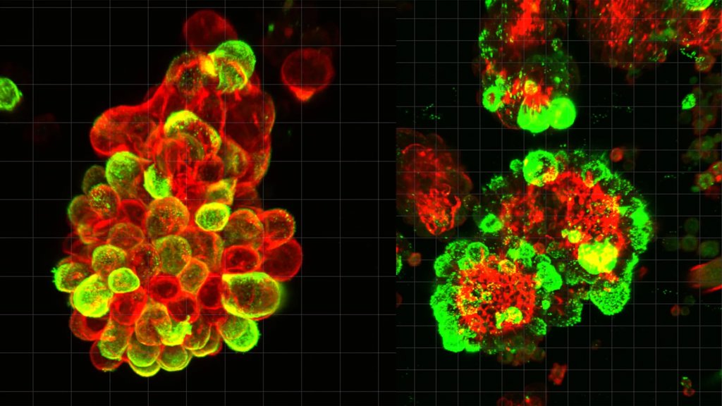 A secret cell alliance may explain why ovarian cancer is so deadly | ScienceDaily