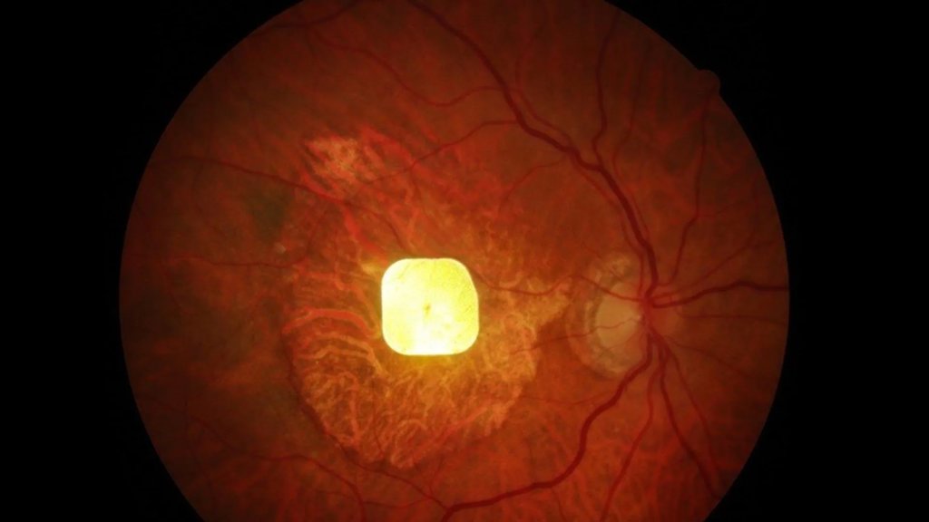 Wireless retinal implant helps blind patients see again | ScienceDaily