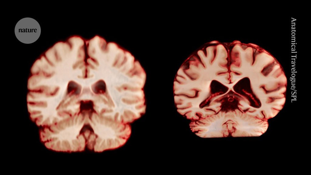 Men’s brains shrink faster than women’s: what that means for Alzheimer’s