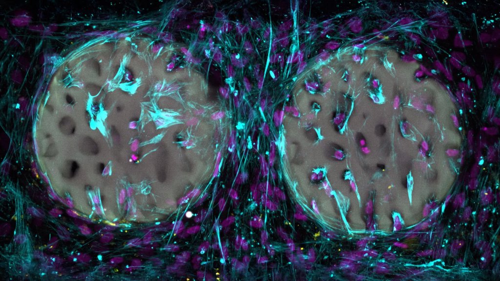 Laser printed hydrogel implant could transform bone repair | ScienceDaily