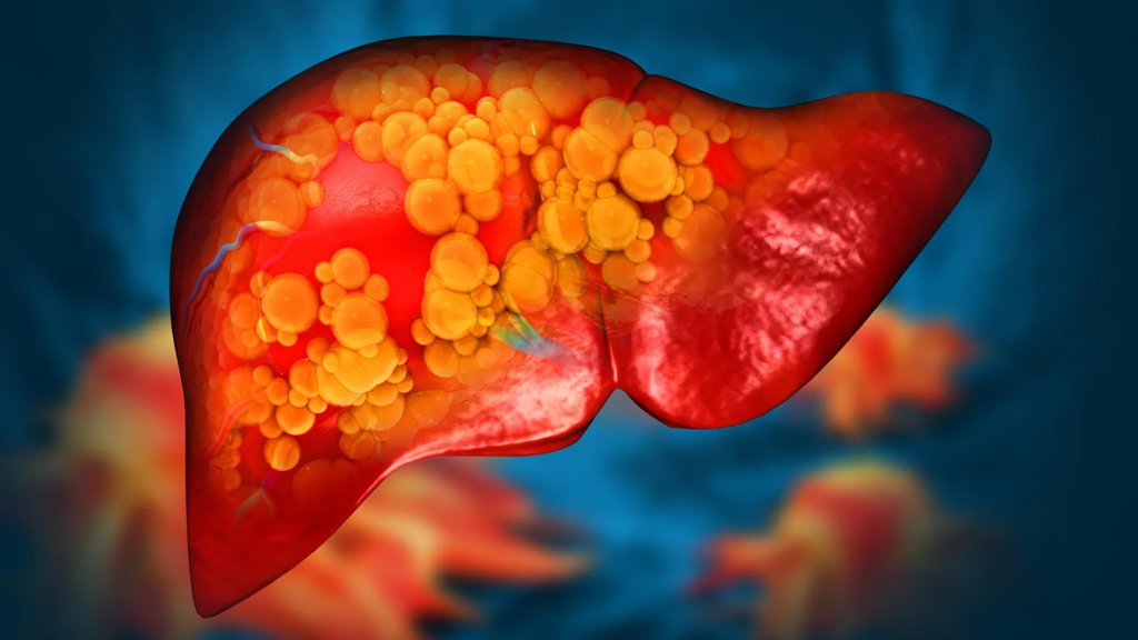 Mayo Clinic discovers rare gene mutation that causes fatty liver disease | ScienceDaily