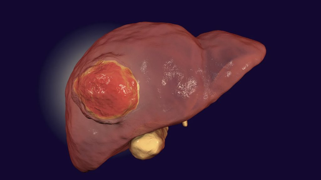 Eating less protein may slow liver cancer growth, study finds | ScienceDaily