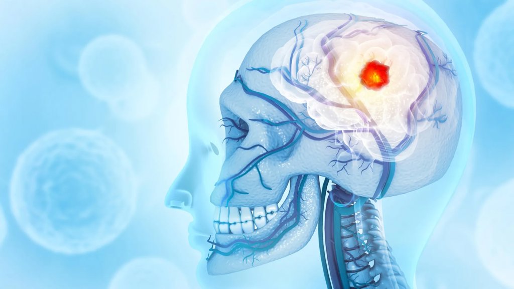 Brain cancer that eats the skull stuns scientists | ScienceDaily