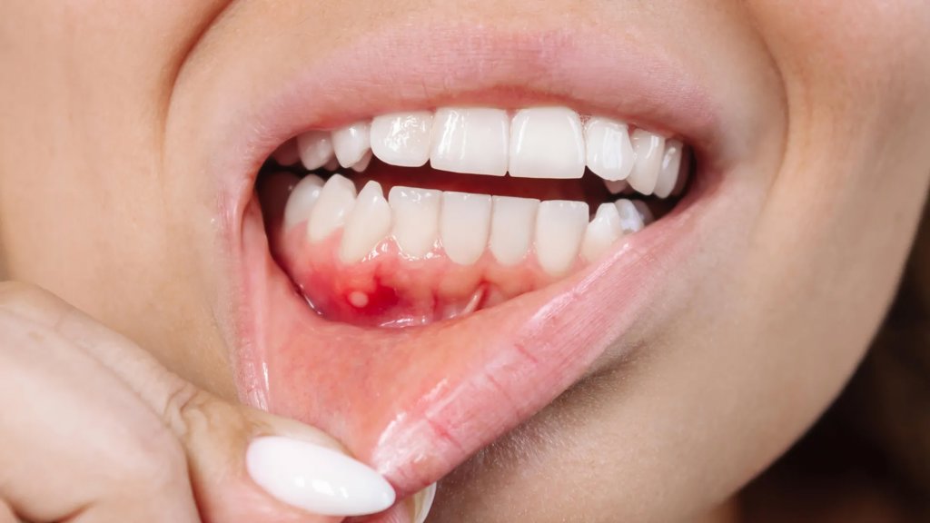 A plant compound might be the secret weapon against gum disease | ScienceDaily