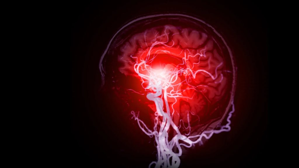 Scientists find hidden brain damage behind dementia | ScienceDaily