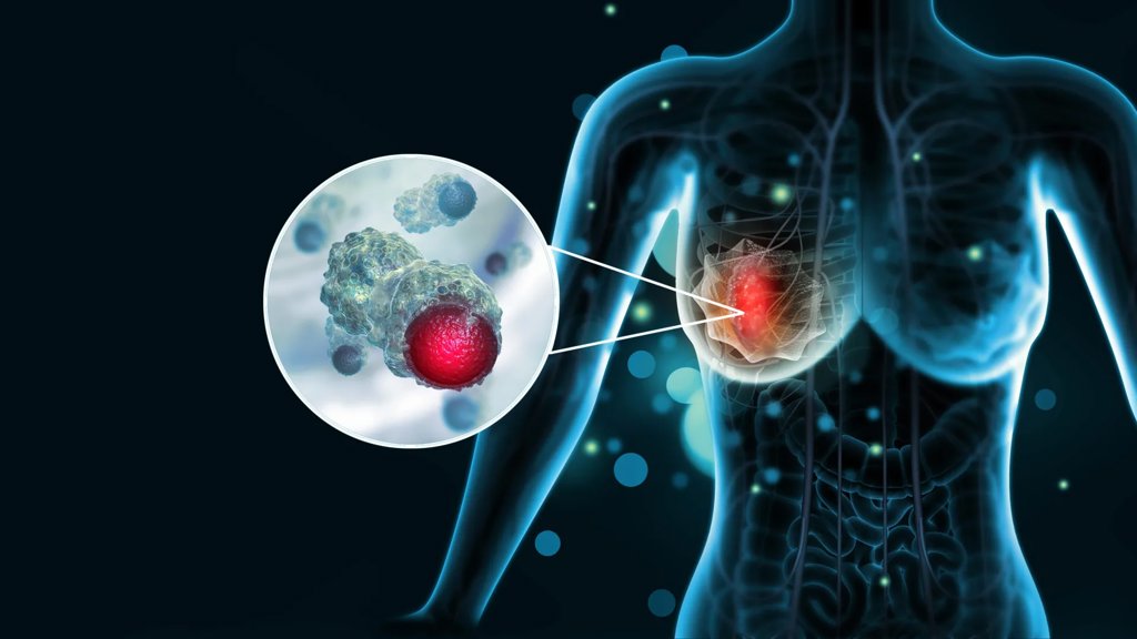 How aggressive breast cancer turns off the immune system | ScienceDaily