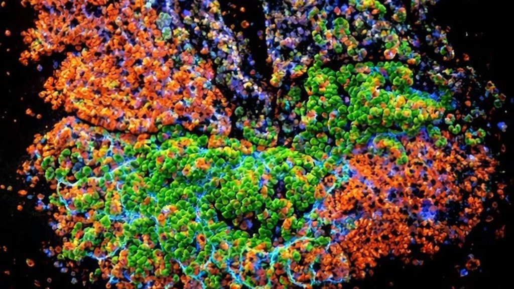 Why chronic gut inflammation can turn into colon cancer | ScienceDaily
