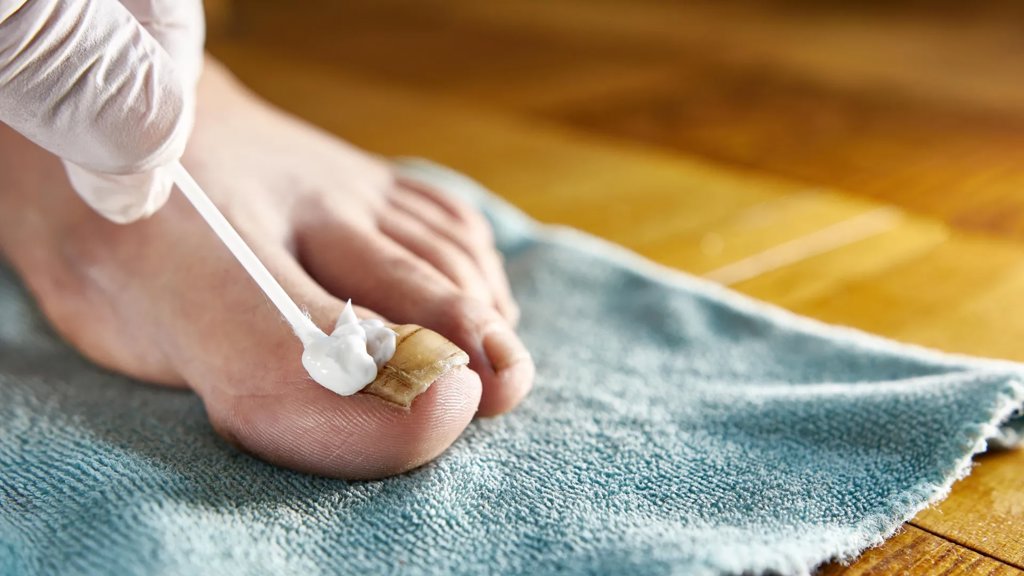 The rotten egg smell that could finally beat nail fungus | ScienceDaily