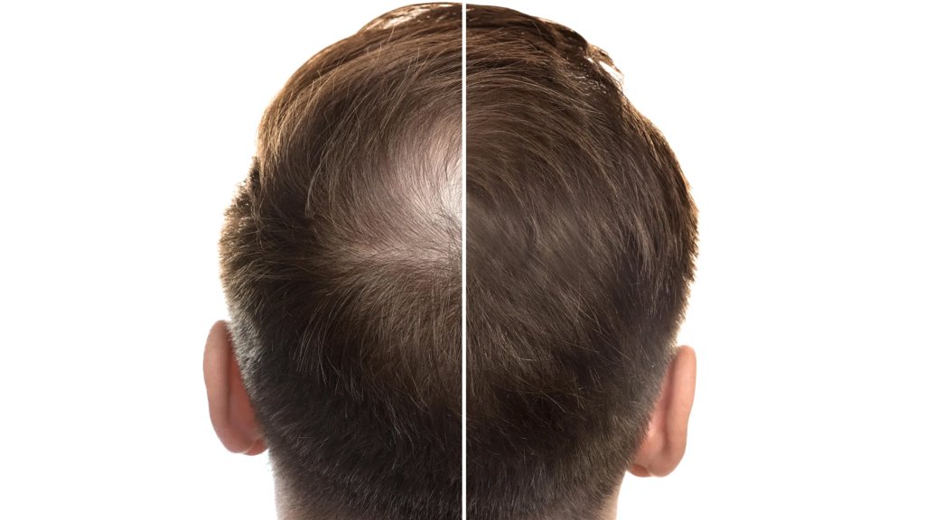 Ancient Chinese medicine could transform hair loss treatment | ScienceDaily