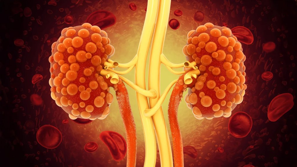 New antibody breakthrough could finally slow polycystic kidney disease | ScienceDaily