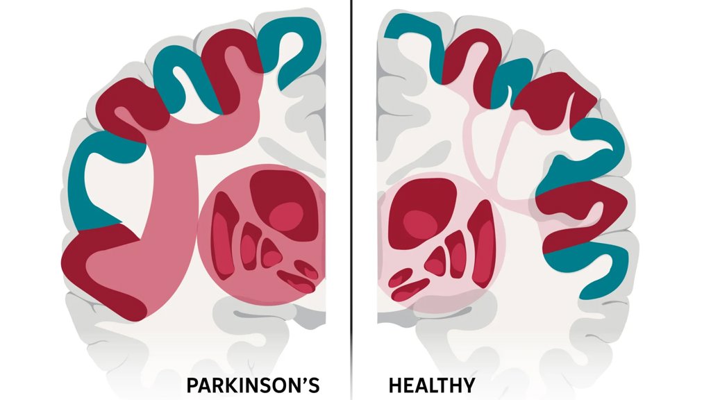 Scientists may have found the brain network behind Parkinson’s | ScienceDaily