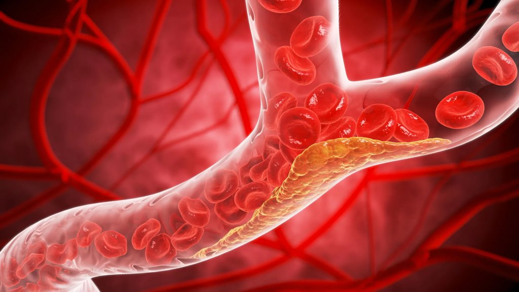 New pill cuts “bad” cholesterol by 60% in major trial | ScienceDaily
