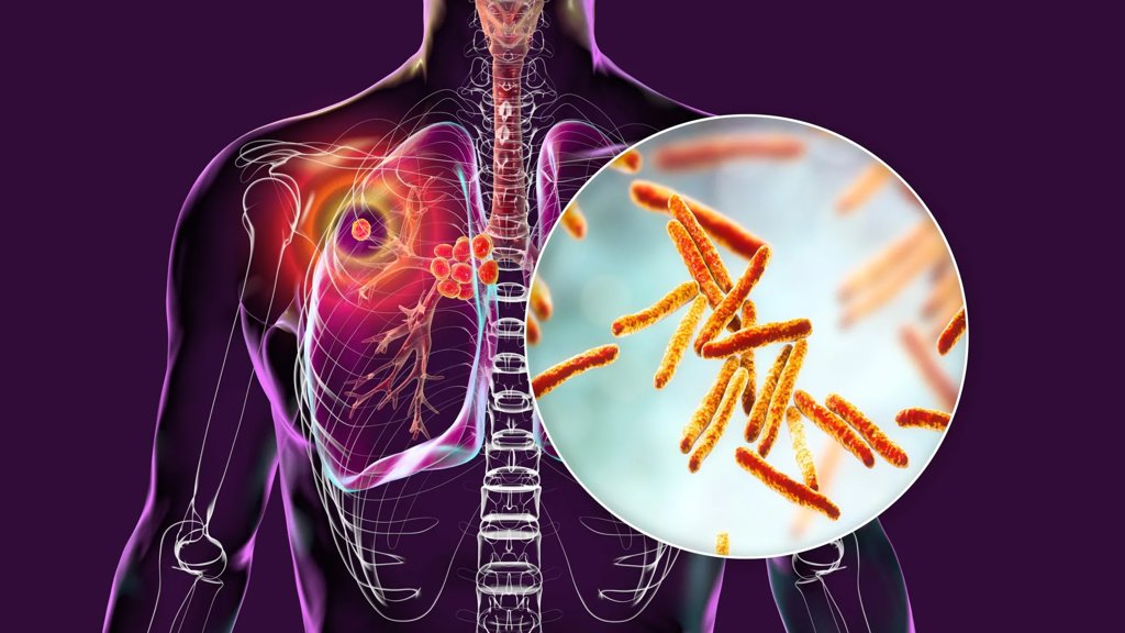 This new drug candidate might finally outsmart tuberculosis | ScienceDaily