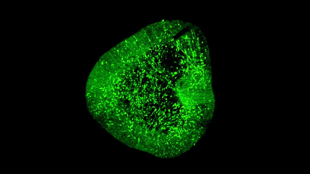 A groundbreaking brain map could revolutionize Parkinson&rsquo;s treatment | ScienceDaily