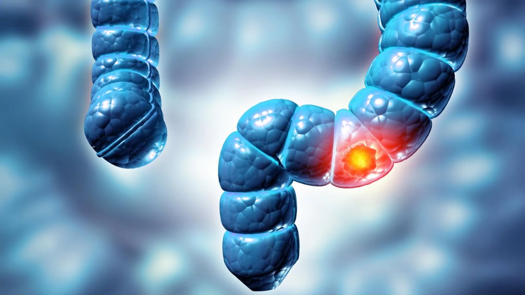 Study finds two types of colon polyps can raise bowel cancer risk fivefold | ScienceDaily