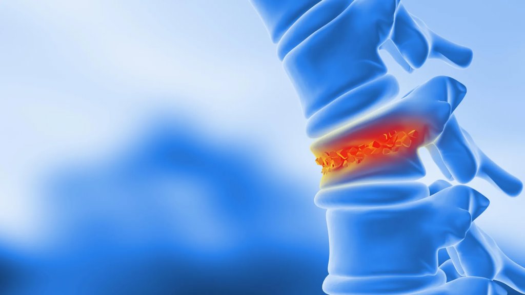 Scientists turn body fat into bone to heal spinal fractures | ScienceDaily