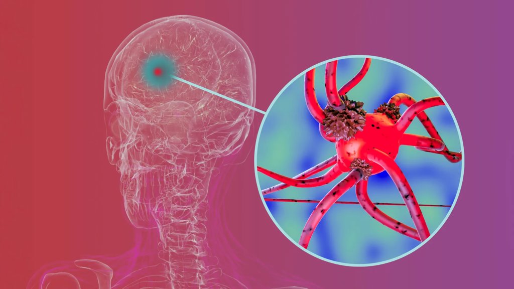 Researchers block key protein that helps Parkinson’s spread through the brain | ScienceDaily