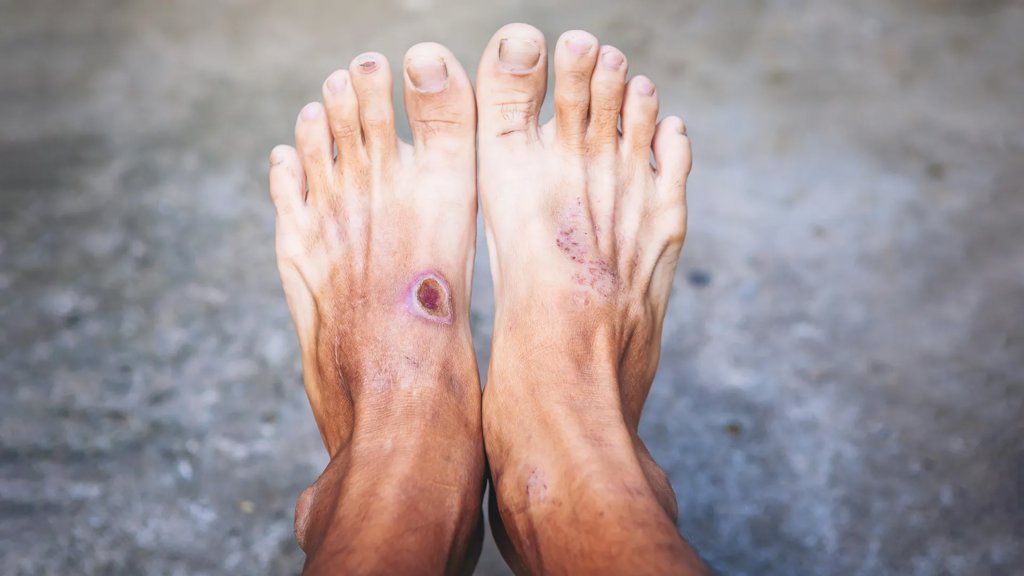 A global DNA study reveals a hidden threat in diabetic foot infections | ScienceDaily
