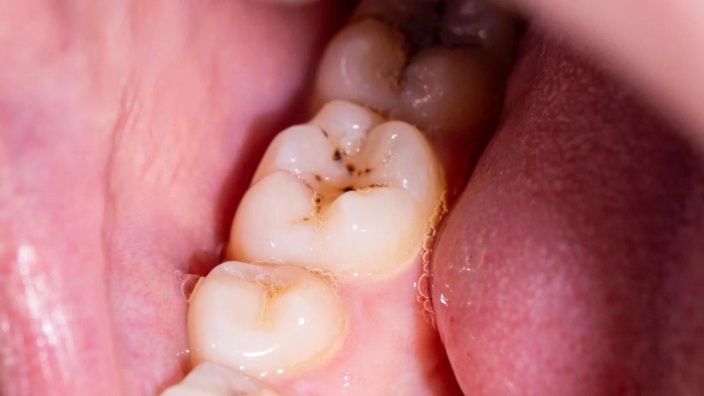 Goodbye, cavities? New gel could regrow tooth enamel | ScienceDaily