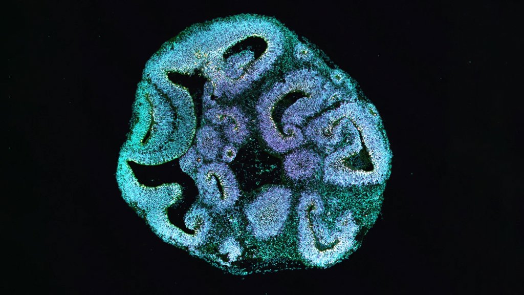 Scientists reveal why some brains stop growing too soon | ScienceDaily