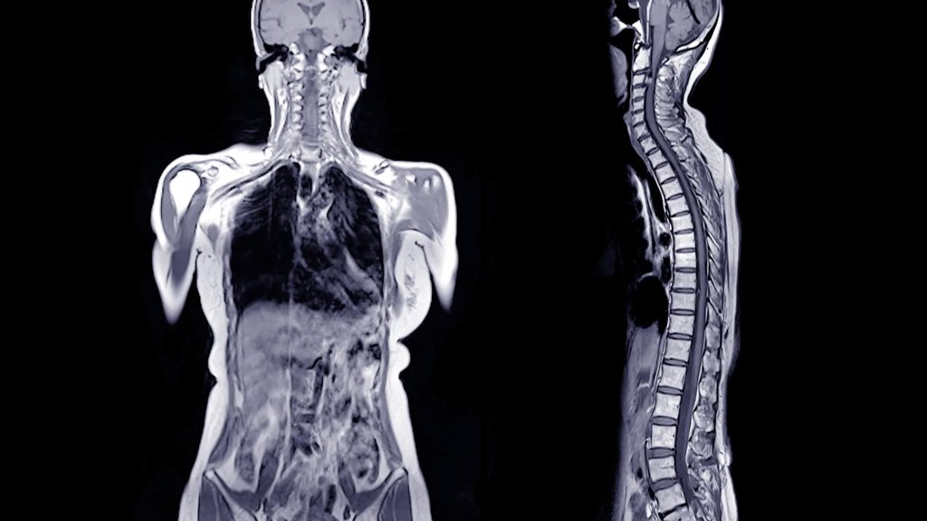 He ate a hamburger and died hours later. Doctors found a shocking cause | ScienceDaily