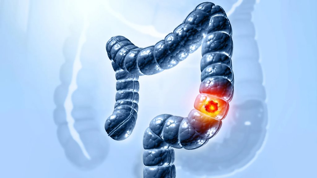 Colon cancer is surging in younger adults and doctors are alarmed | ScienceDaily