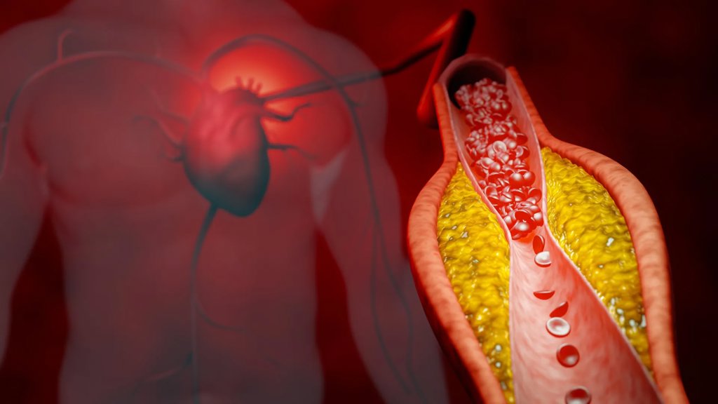 New treatment cuts bad cholesterol by nearly 50% without statins | ScienceDaily