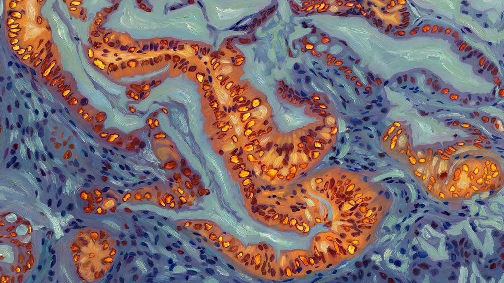 Scientists find the genetic switch that makes pancreatic cancer resist chemotherapy | ScienceDaily