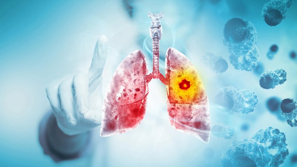 Scientists discover why this deadly lung cancer keeps coming back | ScienceDaily