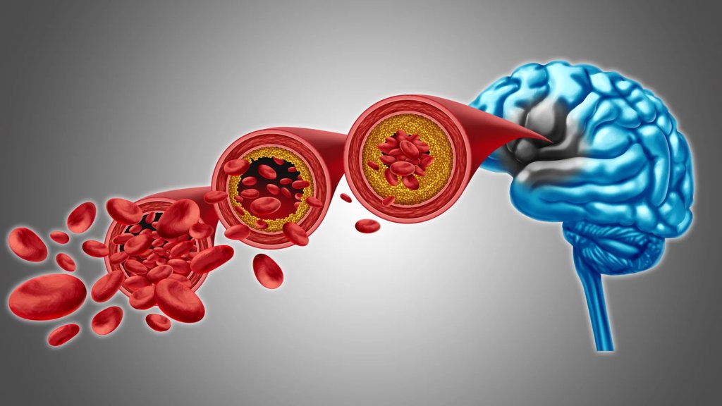 Scientists found a way to restore brain blood flow in dementia | ScienceDaily