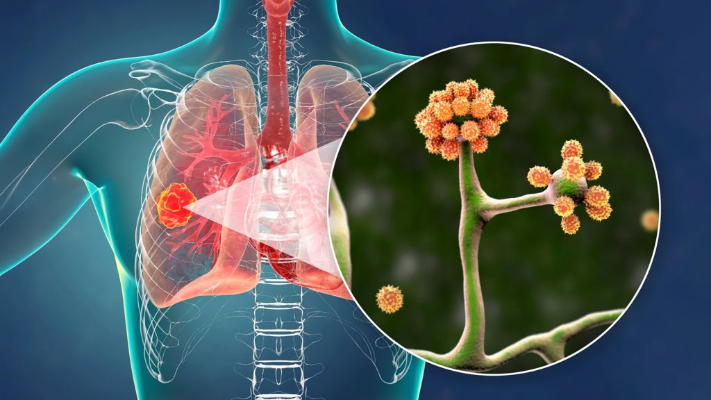 This simple blood protein could stop a deadly black fungus | ScienceDaily
