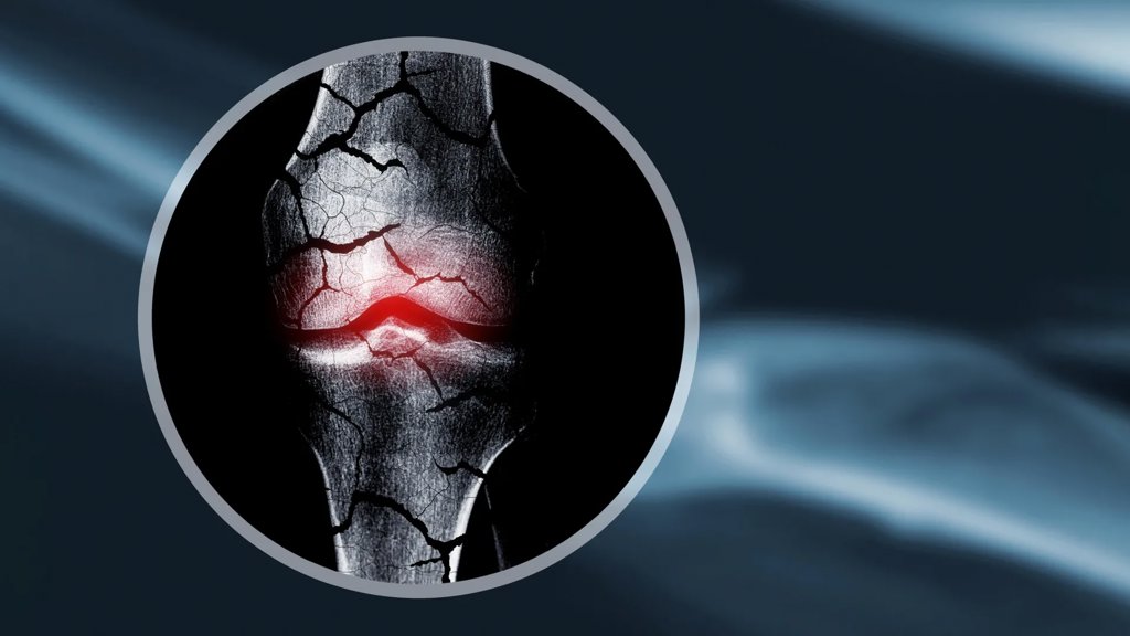 These “forever chemicals” could be weakening kids’ bones for life | ScienceDaily