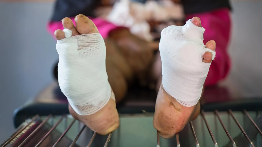 New oxygen gel could prevent amputation in diabetic wound patients | ScienceDaily