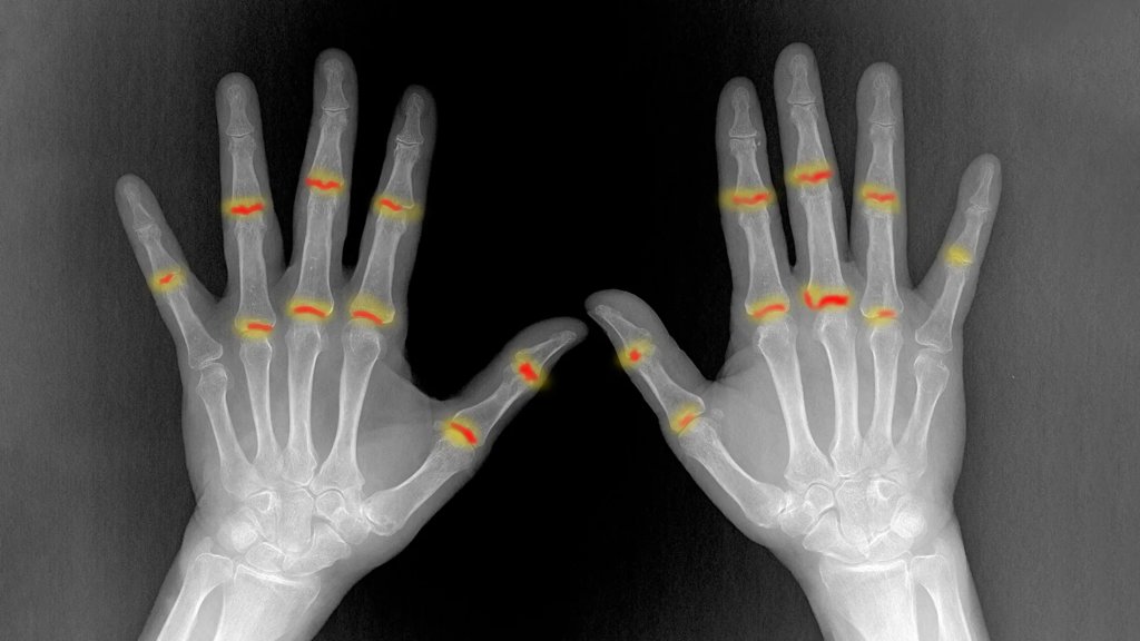 Scientists uncover why psoriasis can turn into joint disease | ScienceDaily