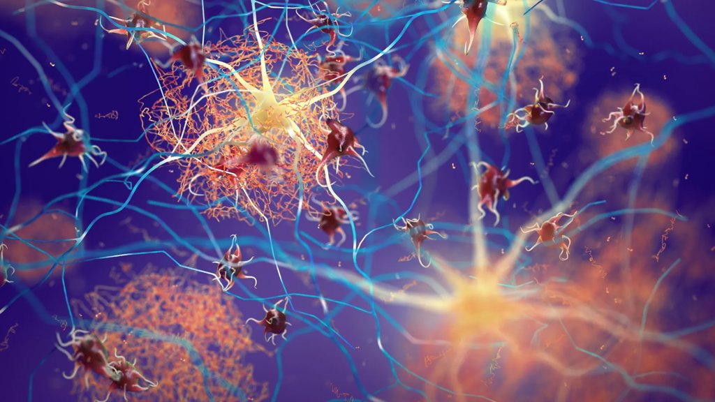 Hidden Alzheimer&rsquo;s warning signs found in Parkinson&rsquo;s patients without dementia | ScienceDaily