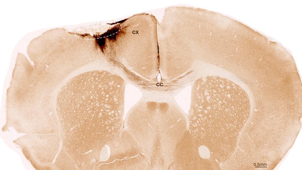 Stem cells reverse stroke damage and restore movement in mice | ScienceDaily